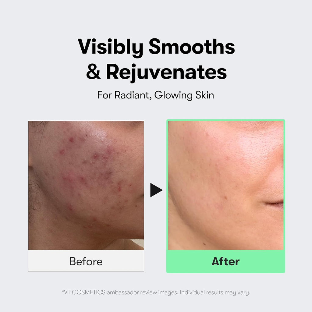 CICA Reedle Shot 300, Advanced Night Exosome, Microneedling Serum, Centella Asiatica, Hyaluronic Acid, Propolis, Soft Skin, Regeneration, Glass Skin, Korean Skin Booster 1.69Fl Oz (50Ml) | Spicule, Pore Care & Exfoliation, Exosome & Centella Asiatica, Glass Skin & Smooth Texture, 1.69 Fl Oz / 50Ml